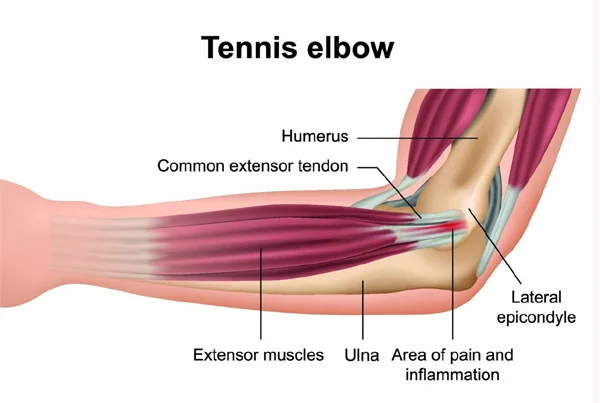 Physiotherapy