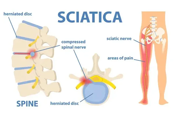 Sciatica / à¤¸à¤¾à¤‡à¤Ÿà¤¿à¤•à¤¾