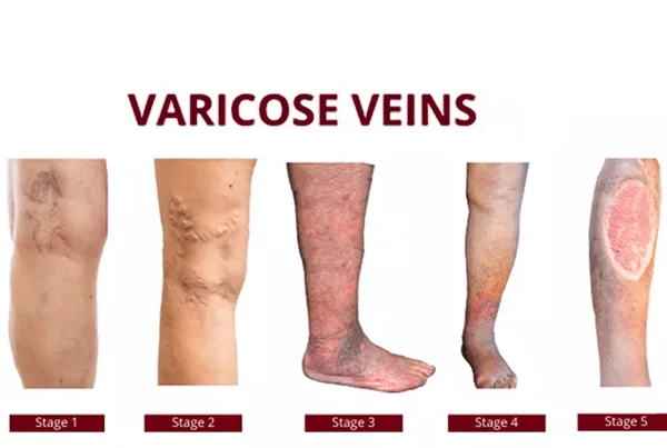 Varicose Veins / à¤µà¥‡à¤°à¤¿à¤•à¥‹à¤¸ à¤µà¥‡à¤‚à¤¸ 